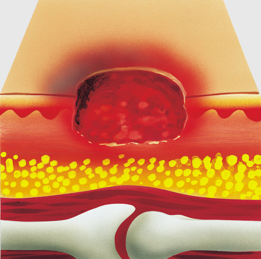 2. stupeň proleženiny - dekubitus