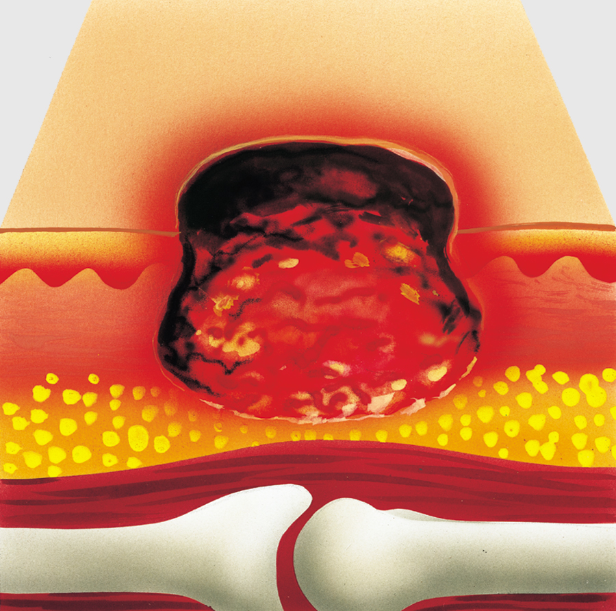 3. stupeň proleženiny - dekubitus