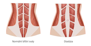 Normální břišní svaly a diastáza