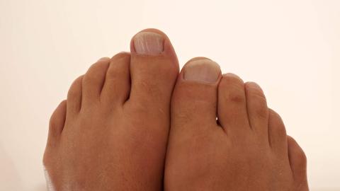 Kladívkové prsty na nohou
