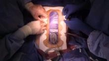 Rychlejší hojení infikovaných ran v cévní chirurgii Hartmann